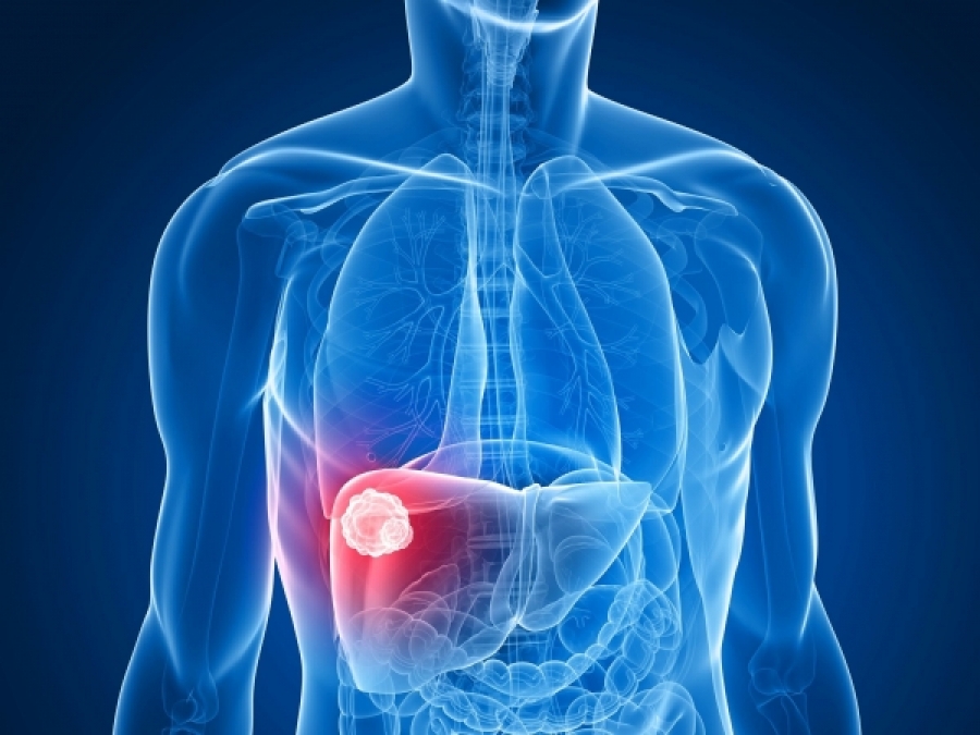 Liver Cancer (HCC) Treatment Options